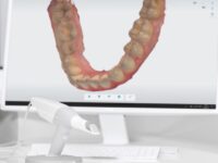 3Dスキャナー　歯科